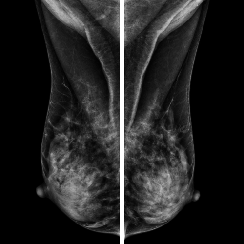 mamografinasilcakilir