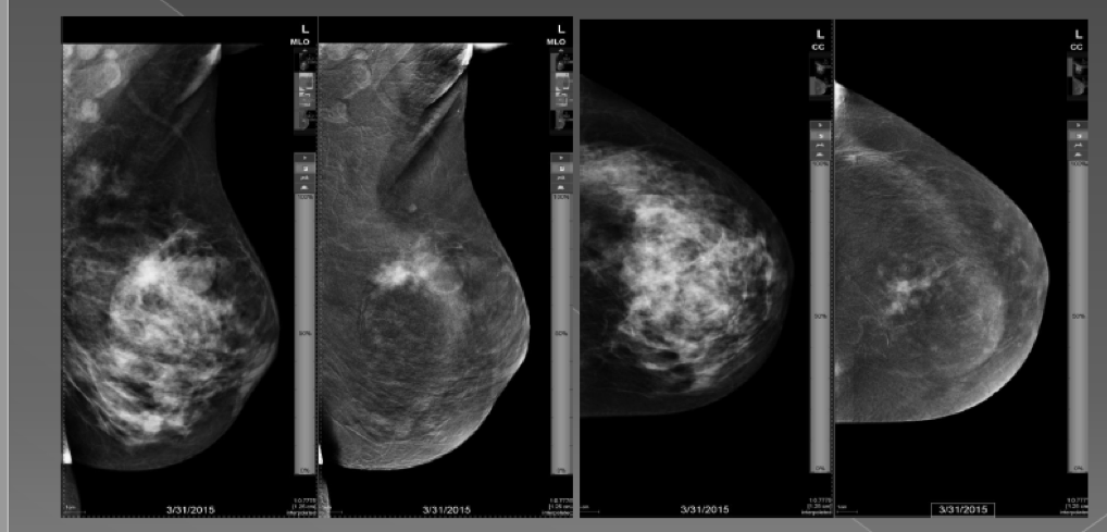 memekanseritanısımamografi