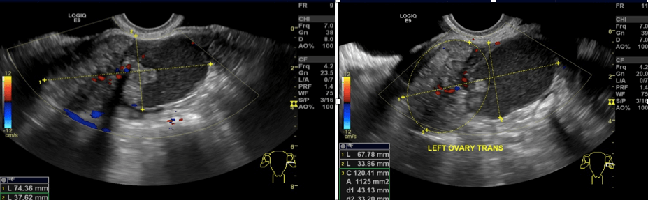 transvajinalultrasontespit